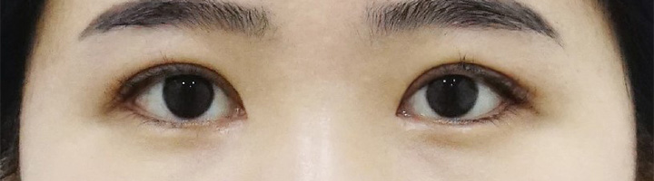 앞트임 뒤트임 윗트임 밑트임 수술 후 48