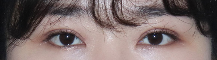 뒤트임 밑트임 눈매교정 수술 후 44