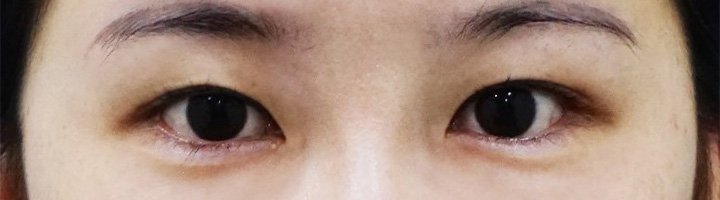 앞트임 윗트임 수술 전 27