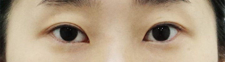 뒤트임 밑트임 눈매교정 수술 전 88