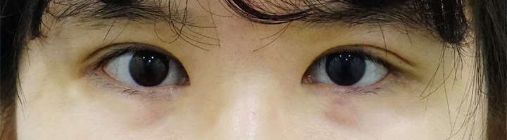 앞트임 뒤트임 윗트임 밑트임 눈매교정 수술 후 34