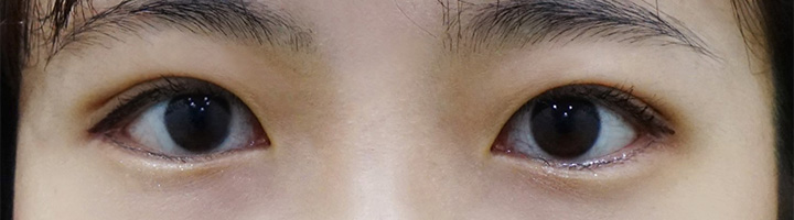 뒤트임 밑트임 눈매교정 수술 후 2