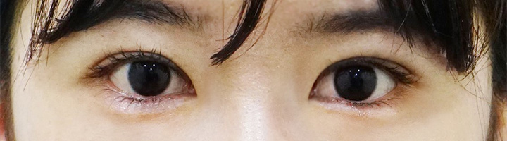 앞트임 윗트임 수술 후 27