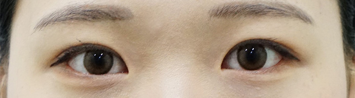 절개법쌍꺼풀 수술 후 170