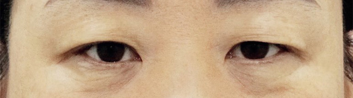눈밑지방재배치 상안검성형술 하안검성형술 수술 전 6