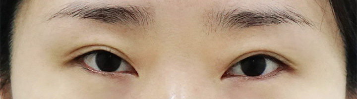 절개법쌍꺼풀 수술 전 164