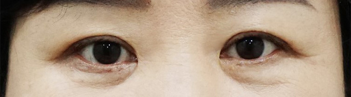 눈밑지방재배치 상안검성형술 하안검성형술 수술 후 6