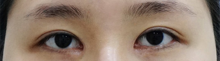 앞트임복원 윗트임 수술 전 28