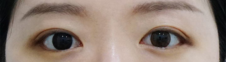 뒤트임 밑트임 수술 후 57