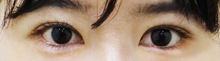 앞트임 윗트임 수술 후 45