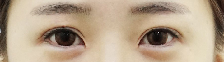 앞트임 뒤트임 밑트임 수술 전 90