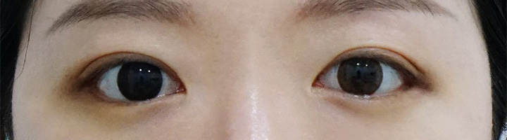 뒤트임 밑트임 수술 후 5