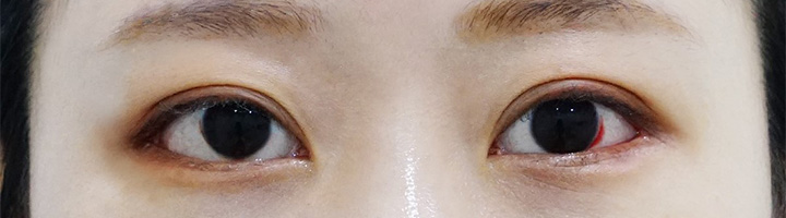 뒤트임복원 밑트임 수술 후 39