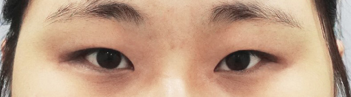 뒤트임 윗트임 밑트임 절개법쌍꺼풀 수술 전 36