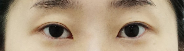 뒤트임 밑트임 눈매교정 수술 전 80
