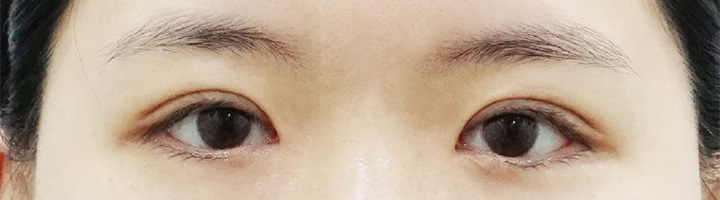 자연유착쌍꺼풀 수술 후 163