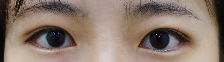 뒤트임 밑트임 눈매교정 수술 후 54