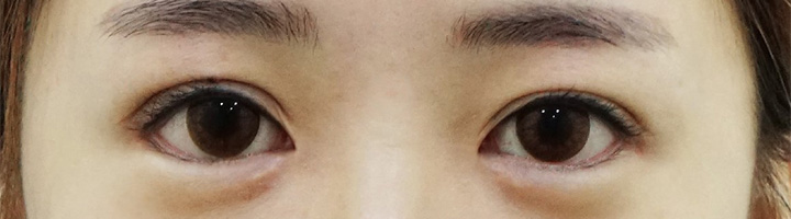 앞트임 뒤트임 밑트임 수술 후 90