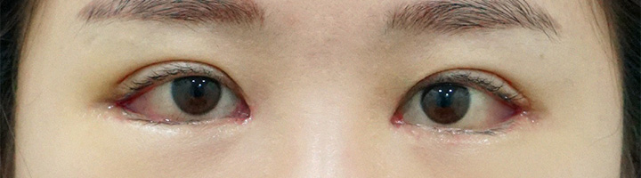 뒤트임복원 앞트임 윗트임 밑트임 수술 후 37