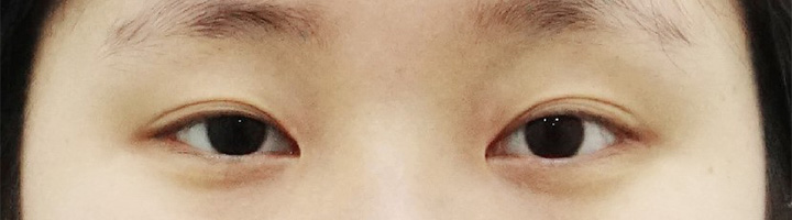 자연유착쌍꺼풀 수술 전 154