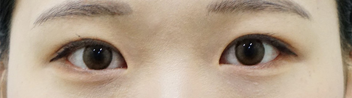 뒤트임 밑트임 절개법쌍꺼풀 수술 후 19