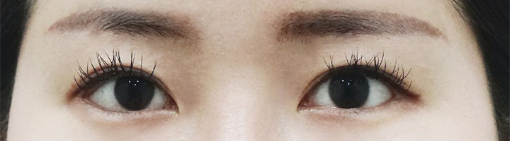 뒤트임 밑트임 수술 후 21
