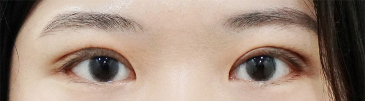 절개법쌍꺼풀 수술 후 169
