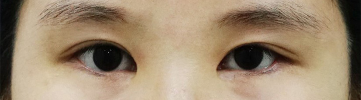뒤트임 윗트임 밑트임 눈매교정 수술 전 55
