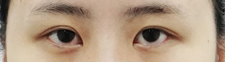 뒤트임 수술 전 28
