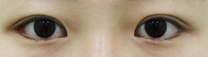 뒤트임 밑트임 자연유착쌍꺼풀 수술 후 6