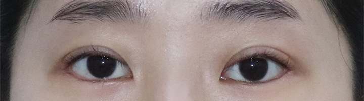 뒤트임 밑트임 눈매교정 수술 후 80