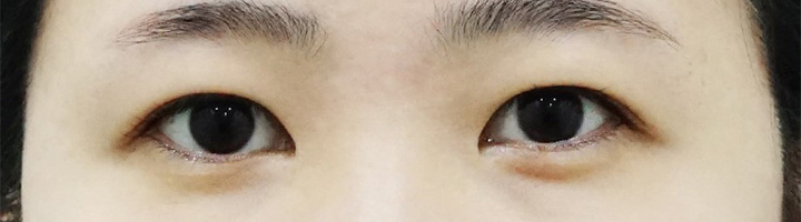 앞트임 뒤트임 윗트임 밑트임 수술 전 16