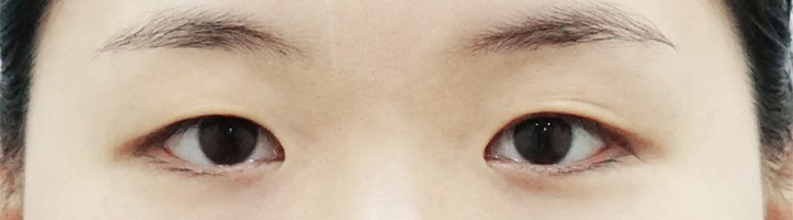 앞트임 수술 전 98