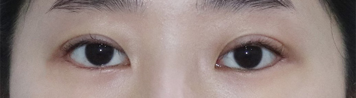 뒤트임 밑트임 눈매교정 수술 후 33