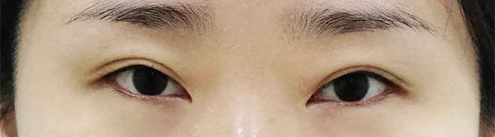 뒤트임 밑트임 눈매교정 수술 전 86
