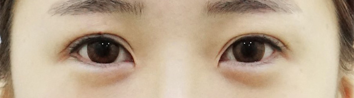 앞트임 뒤트임 밑트임 수술 전 20